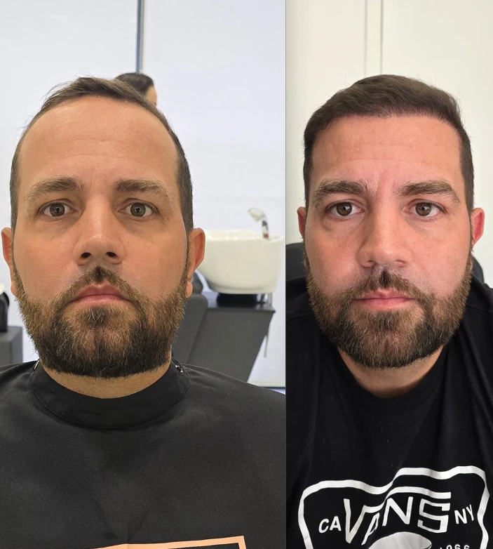 Resultado de transplante capilar: antes e depois
