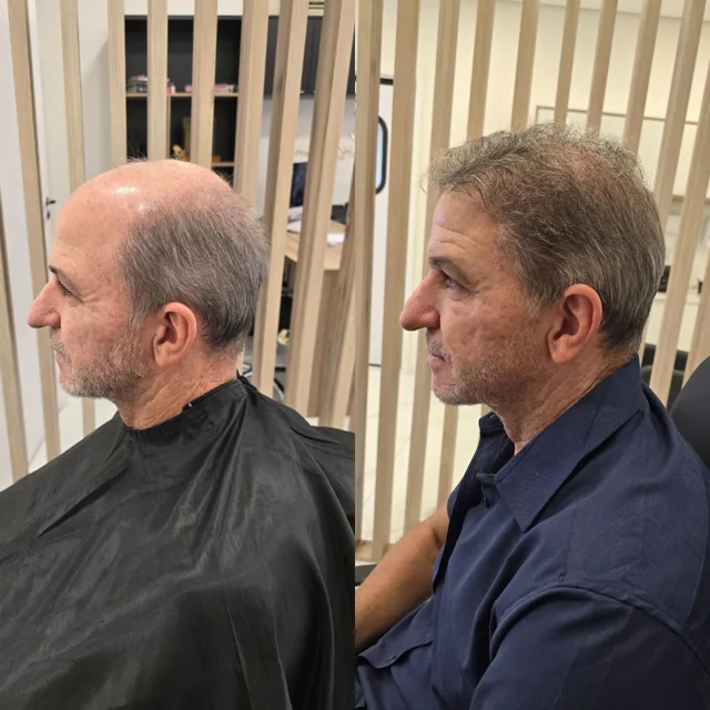 Resultado de transplante capilar: antes e depois