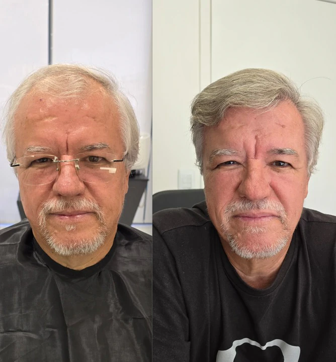 Resultado de transplante capilar: antes e depois