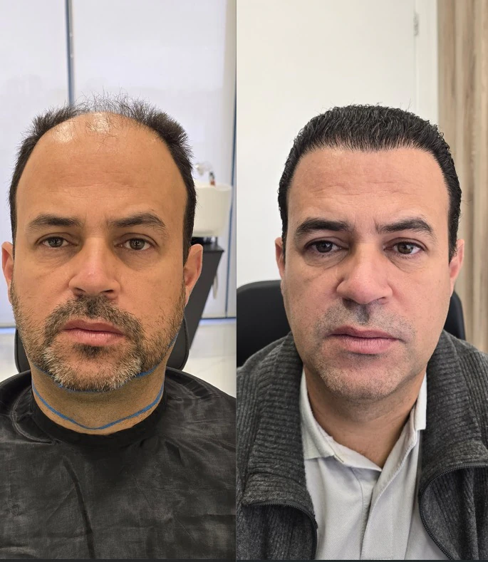Resultado de transplante capilar: antes e depois