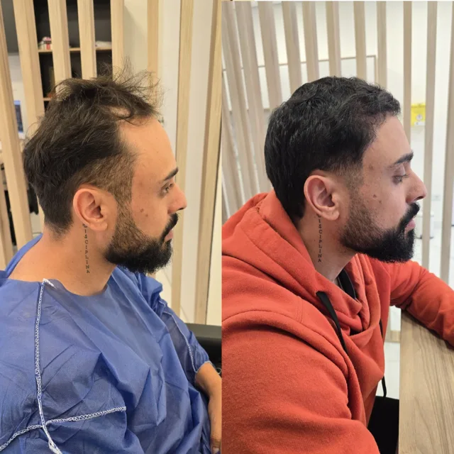Resultado de transplante capilar: antes e depois