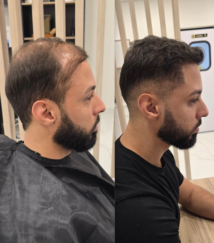 Resultado de transplante capilar: antes e depois