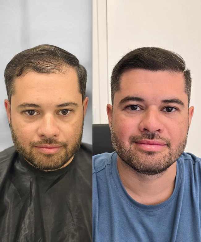 Resultado de transplante capilar: antes e depois