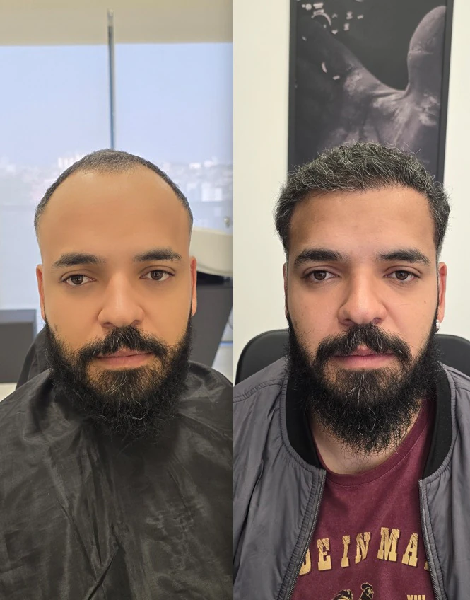 Resultado de transplante capilar: antes e depois