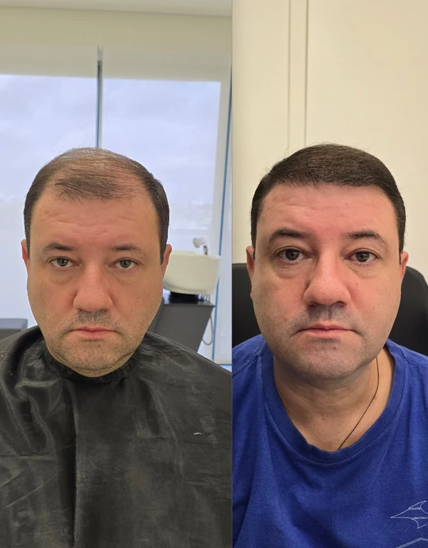 Resultado de transplante capilar: antes e depois