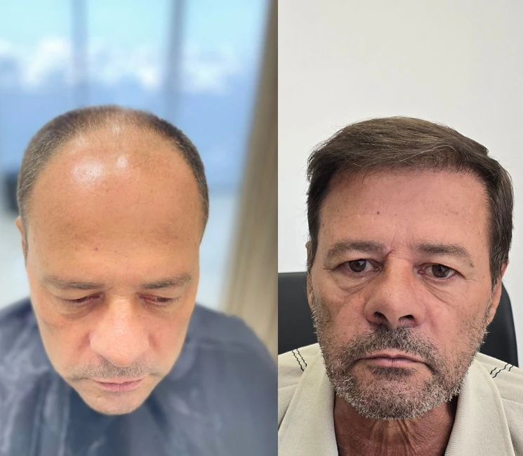 Resultado de transplante capilar: antes e depois