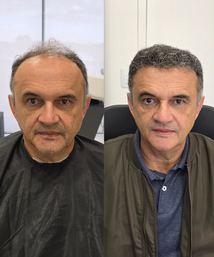 Resultado de transplante capilar: antes e depois