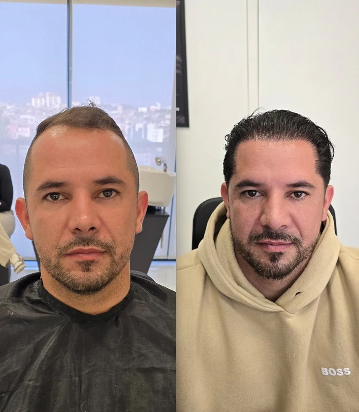 Resultado de transplante capilar: antes e depois
