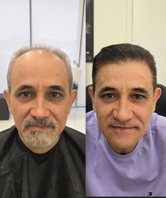 Resultado de transplante capilar: antes e depois