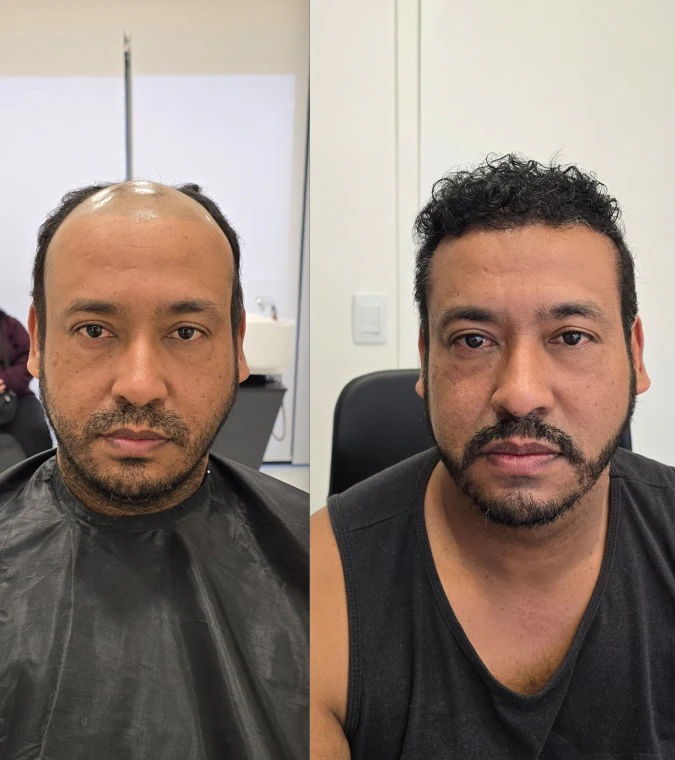 Resultado de transplante capilar: antes e depois