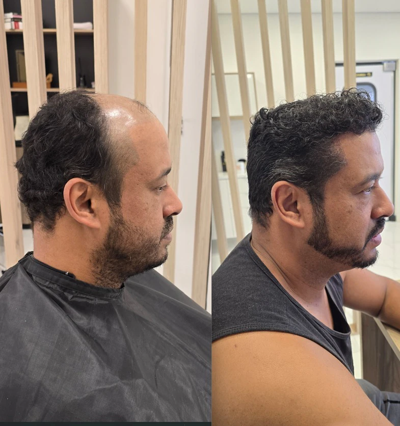 Resultado de transplante capilar: antes e depois
