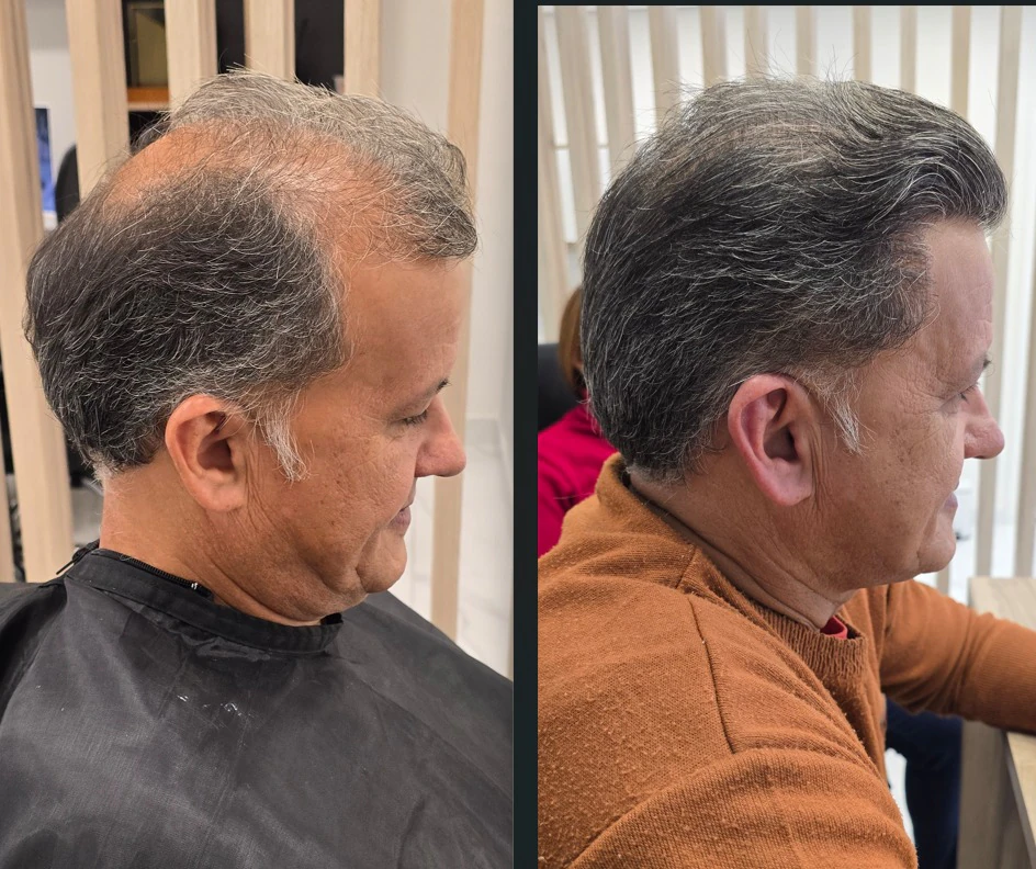 Resultado de transplante capilar: antes e depois