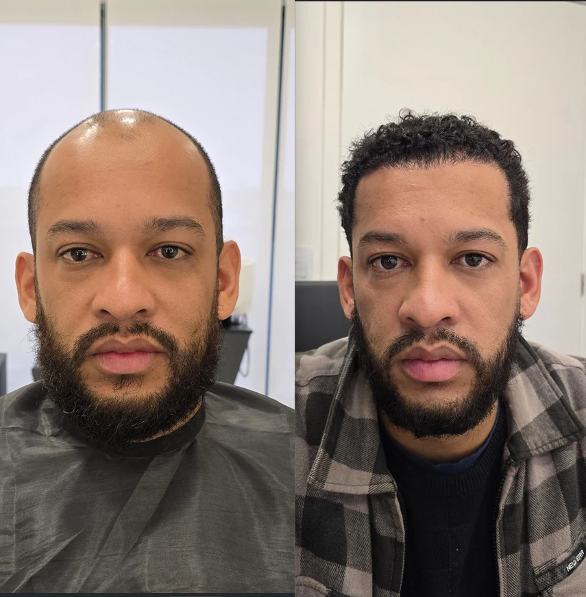Resultado de transplante capilar: antes e depois